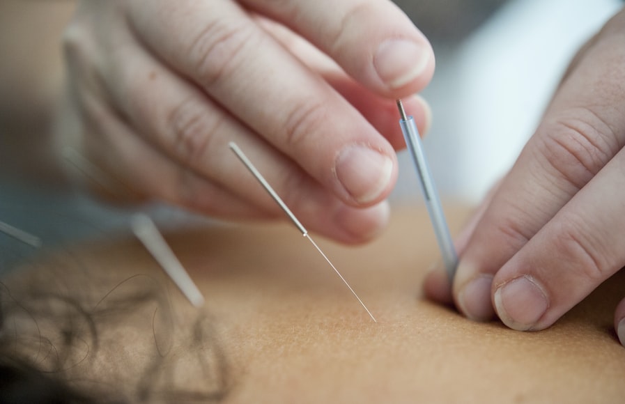 Living with endometriosis acupuncture 