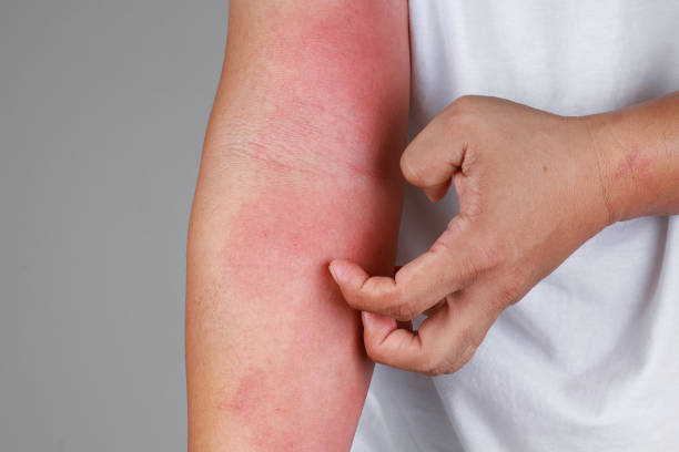 Multiple chemical sensitivity. A close-up of bad psoriasis on a person's arm.