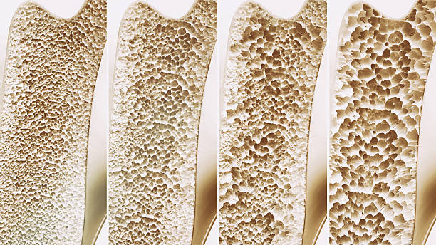 Osteoporosis 4 stages in one picture - 3d rendering